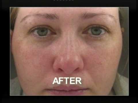 IPL Rejuvenation